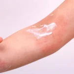 Step-by-Step Guide to Applying Eczedone Cream