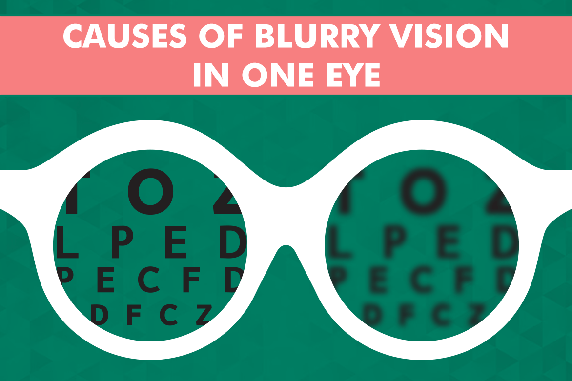 Top 13 Common Causes of Blurry Vision in One Eye