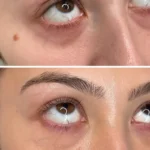 Everything You Need to Know Prf Under Eyes