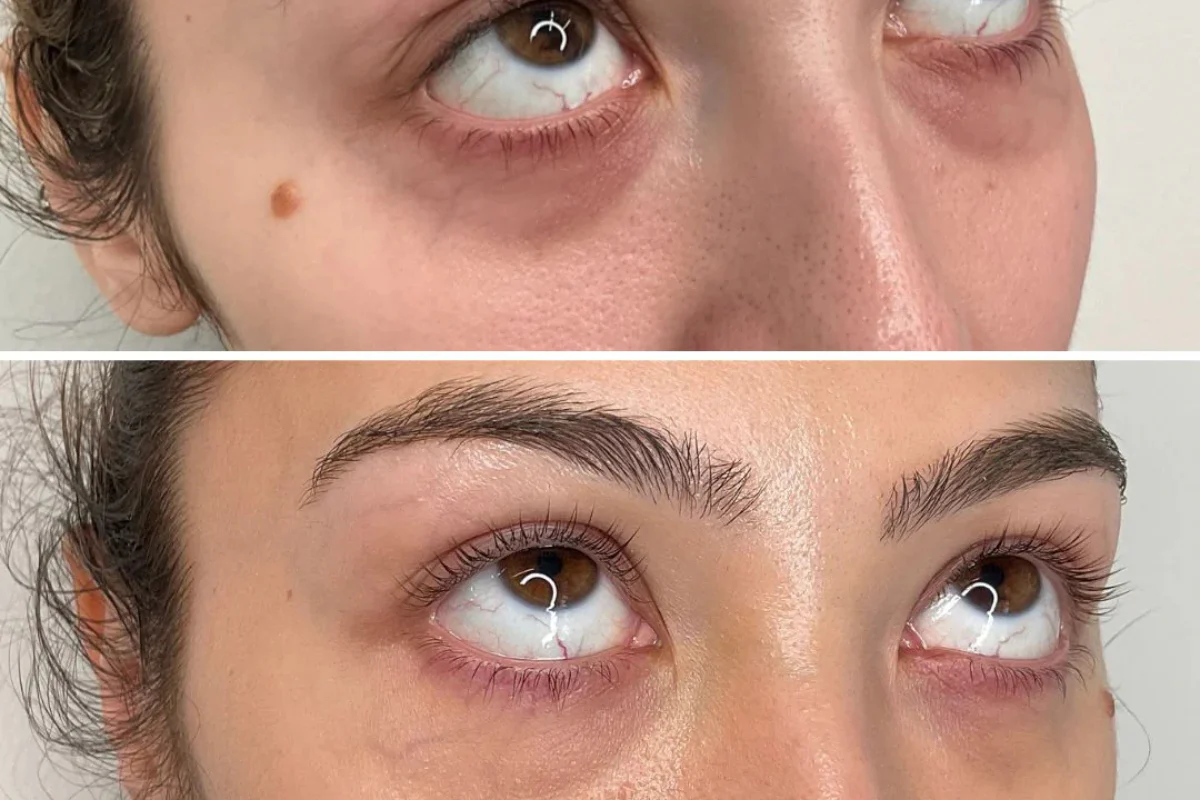 Everything You Need to Know Prf Under Eyes