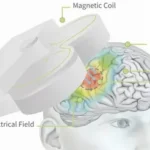 TMS for Tinnitus