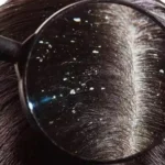 Does Dandruff Cause Hair Loss? Expert Prevention Tips in 2026