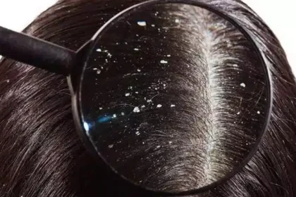 Does Dandruff Cause Hair Loss? Expert Prevention Tips in 2026