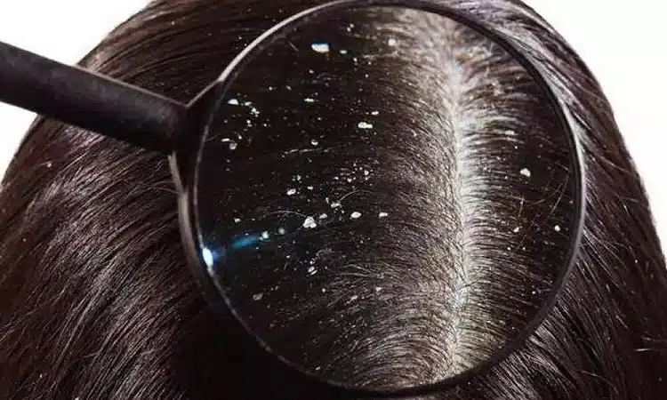 Does Dandruff Cause Hair Loss? Expert Prevention Tips in 2026