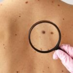 Why Early Skin Cancer Detection Saves Lives: What Most Patients Overlook