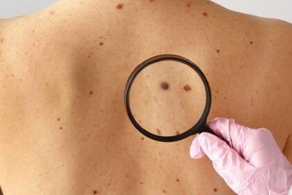 Why Early Skin Cancer Detection Saves Lives: What Most Patients Overlook