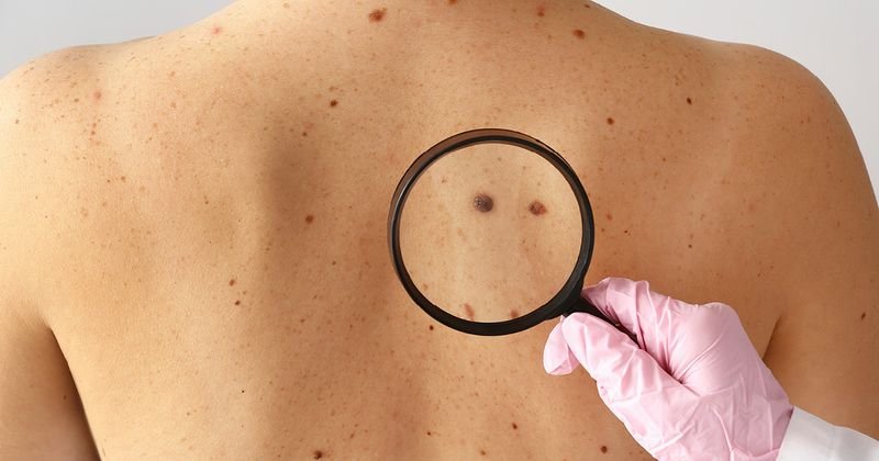 Why Early Skin Cancer Detection Saves Lives: What Most Patients Overlook